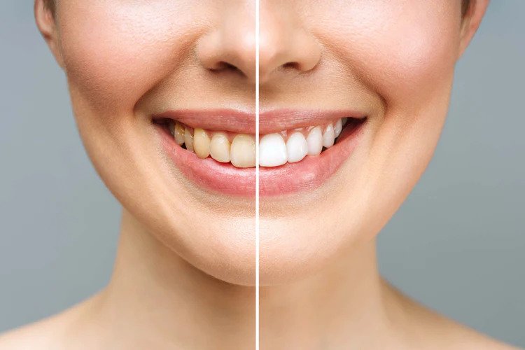 Affordable Teeth Whitening in Scarborough
