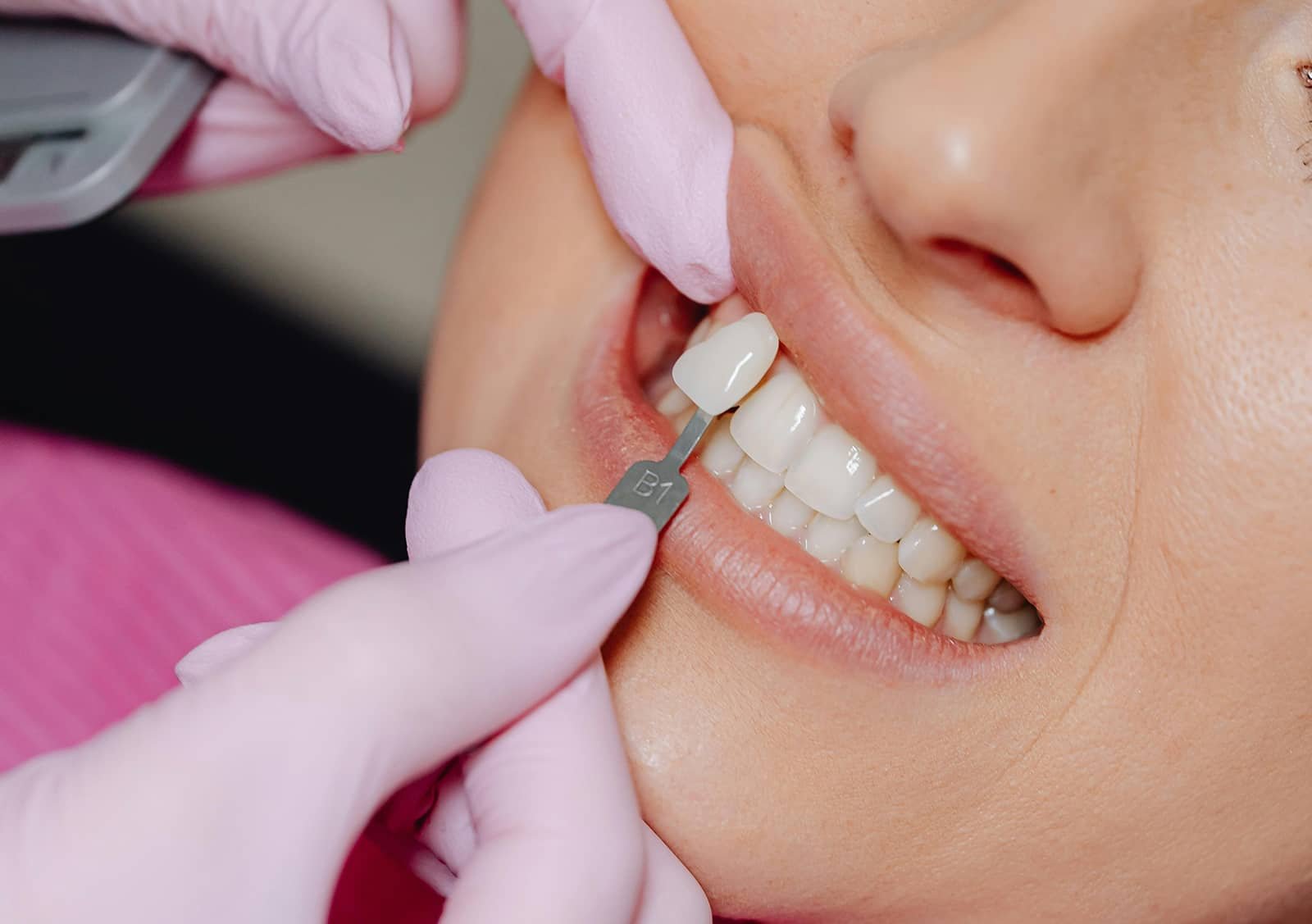 Best value cosmetic dentist in Scarborough - High-quality dental implants for tooth replacement