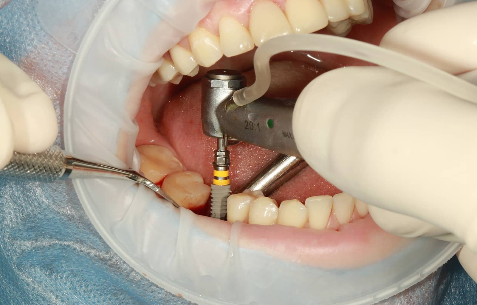Dental Implant in Scarborough by Maral Dental Clinic