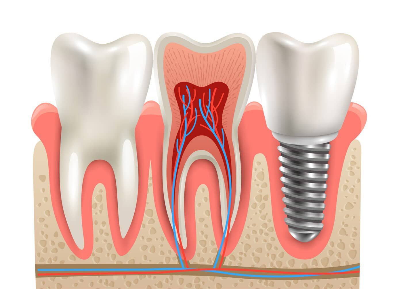 Best Review Dental Implants in Scarborough
