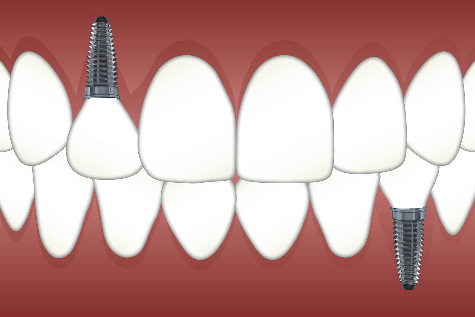 Types of Dental Implants in Scarborough