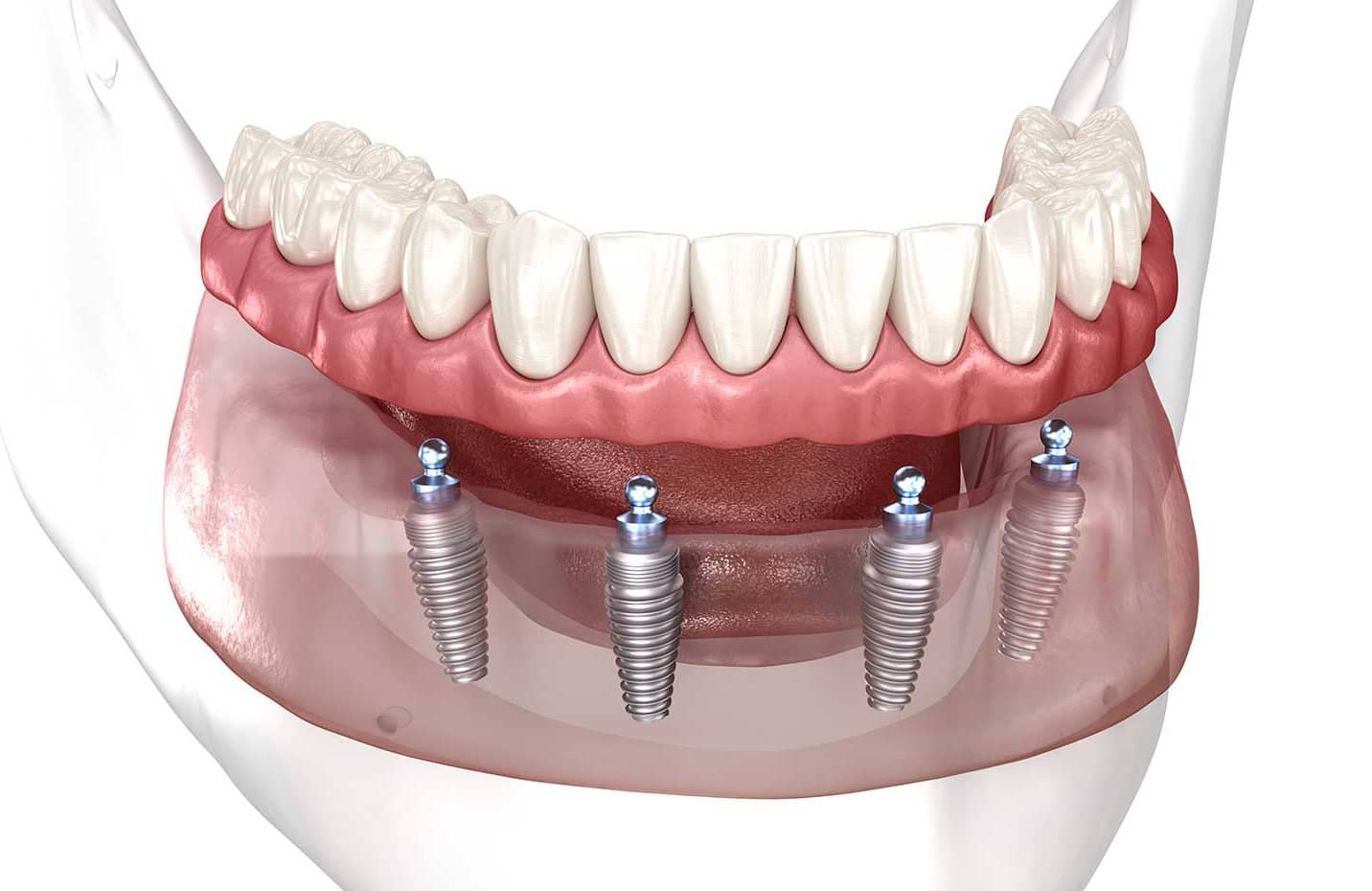 All-on-4 dentures smile with expert denture services Scarborough
