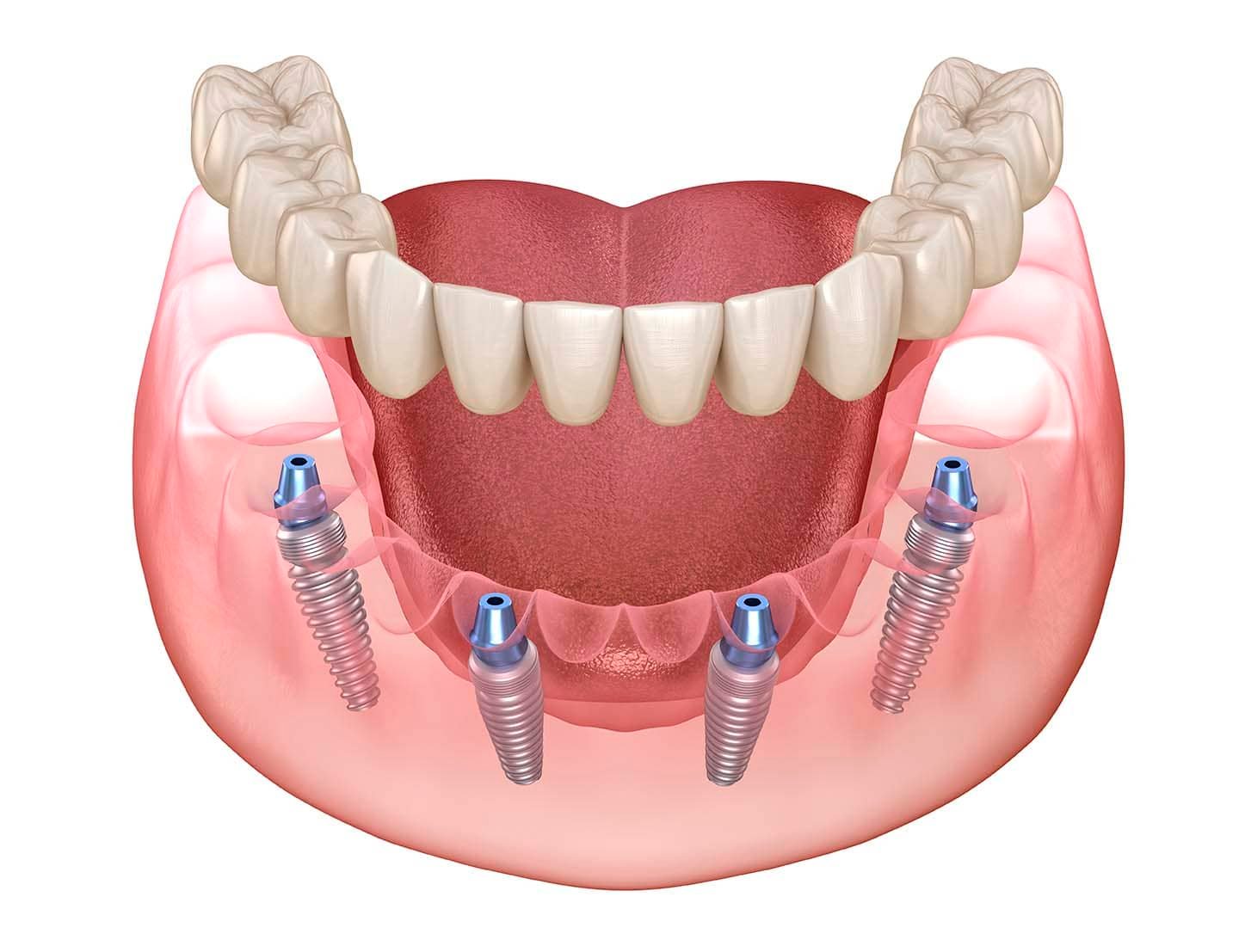 All-on-4 implant denture maral dental clinic your denture specialists Scarborough