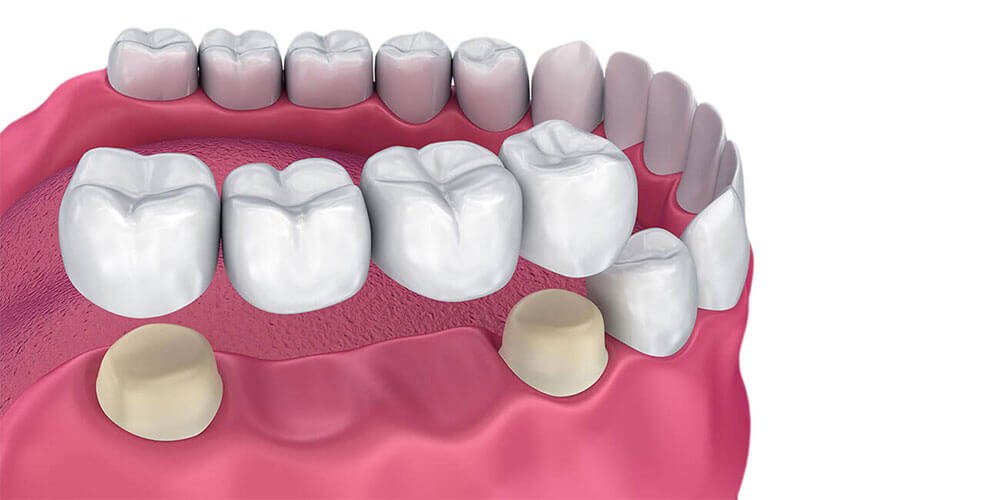 Best Review For Dental Bridge in Scarborough