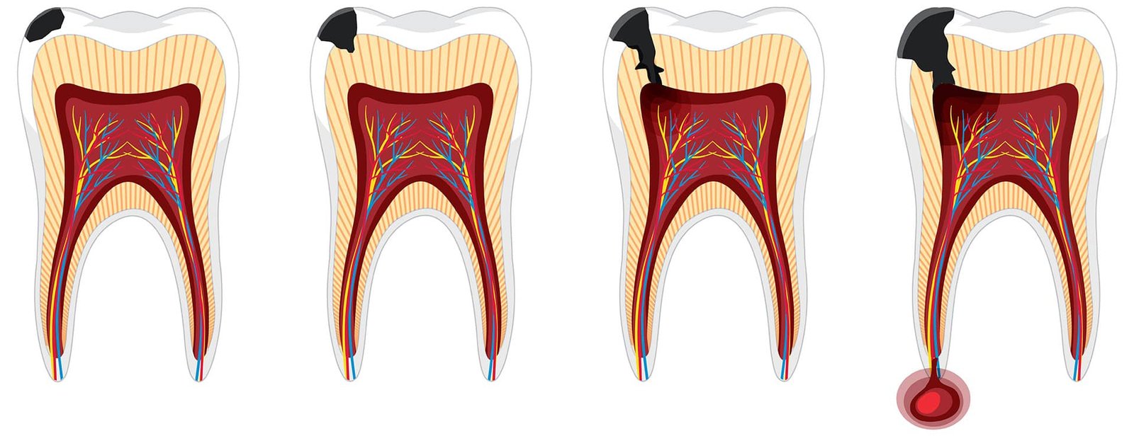 Best root canal therapy Scarborough