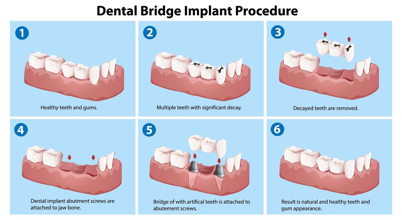 Dental Bridge Implant Procedure in Scarborough