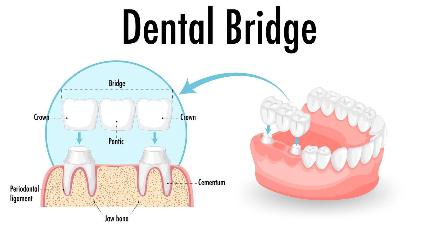 Dental Bridge Placement Process in Scarborough