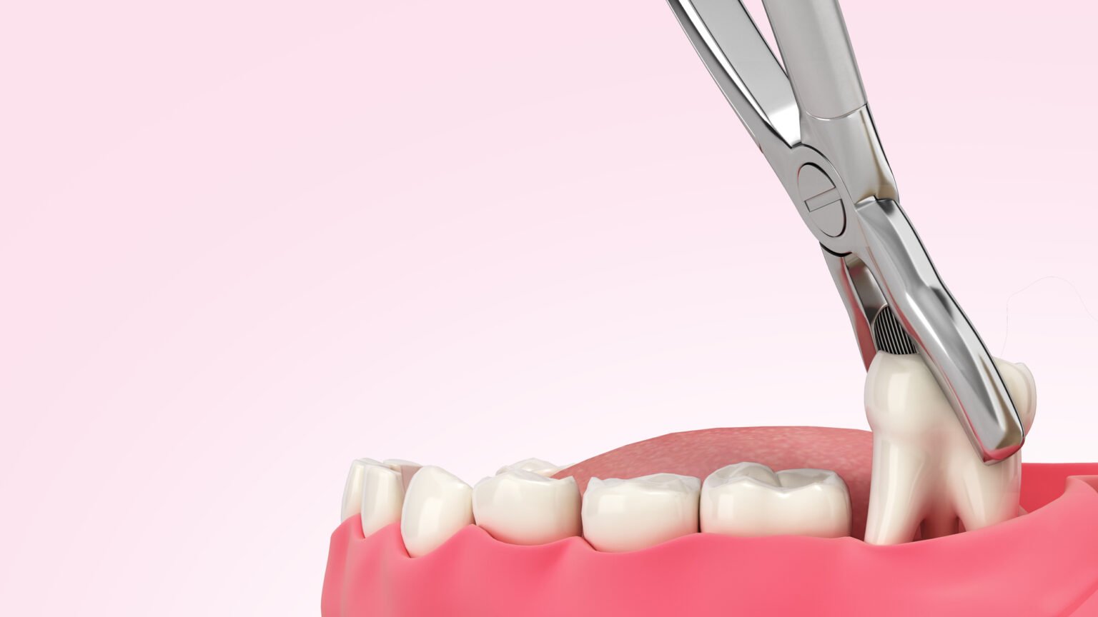 Dental extraction procedure for wisdom teeth removal in Scarborough