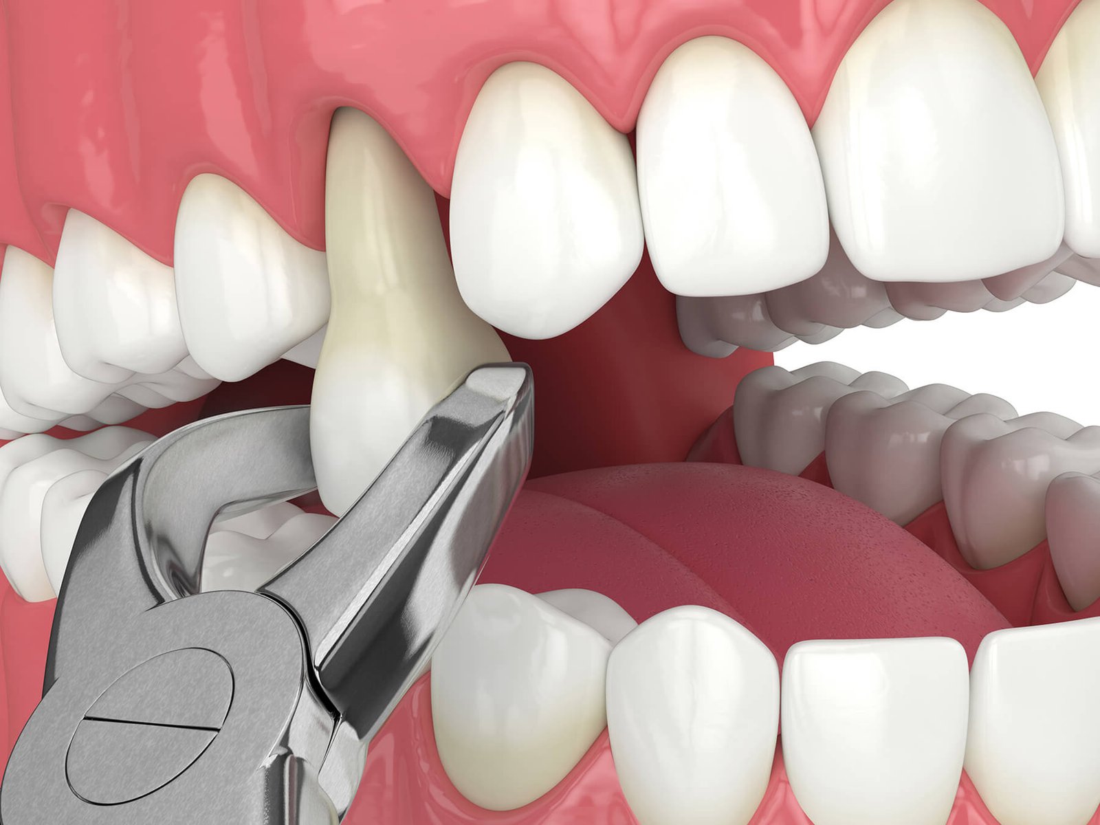 Dental Surgery Extraction in Scarborough