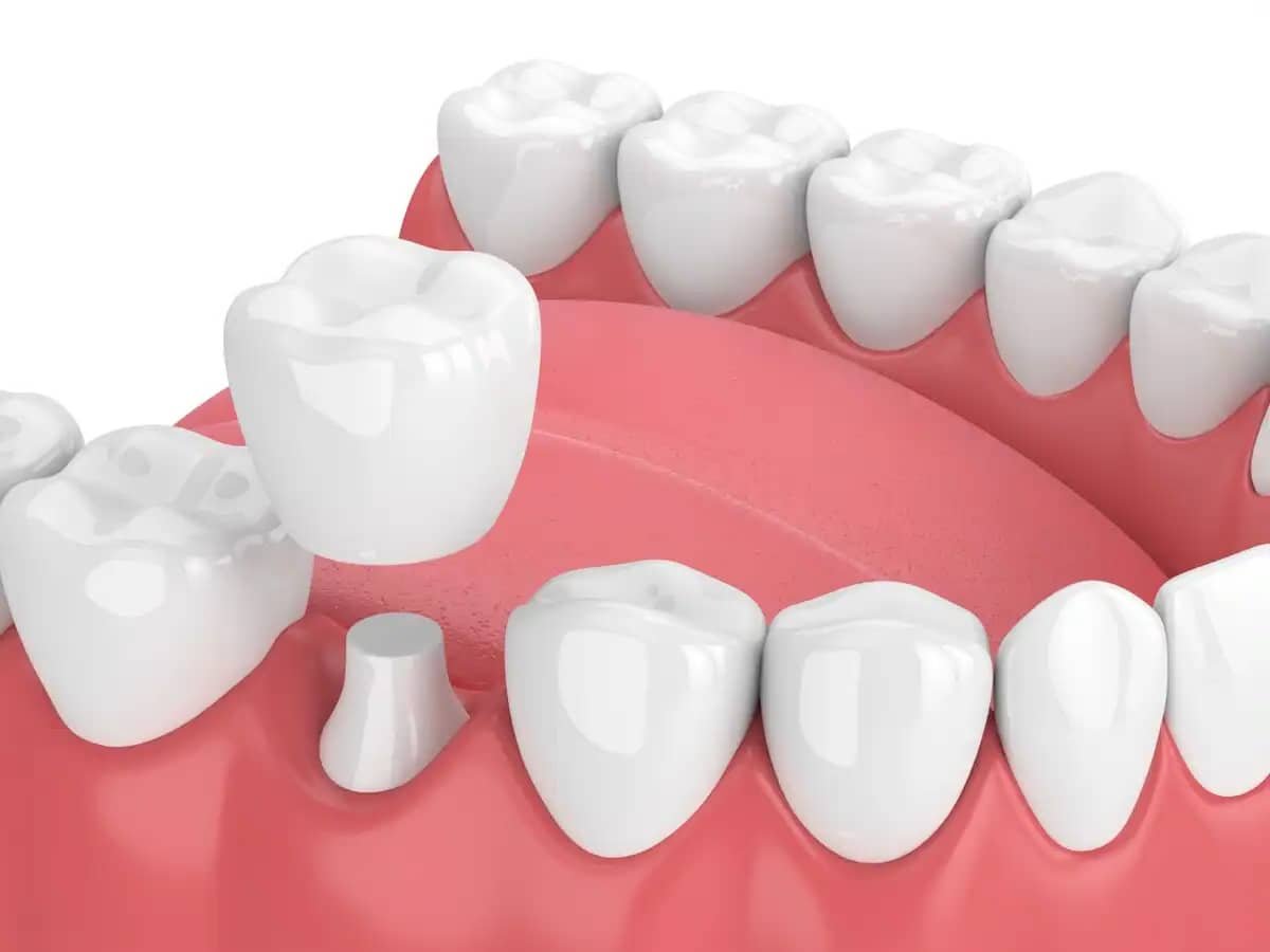 emergency dentist for crown in Scarborough