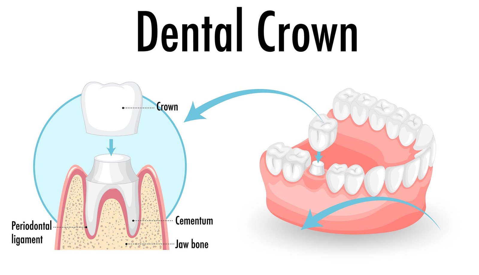 painless dental crown in Scarborough