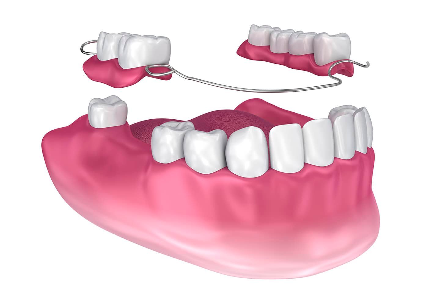 Partial dentures Scarborough trusted partner for denture care