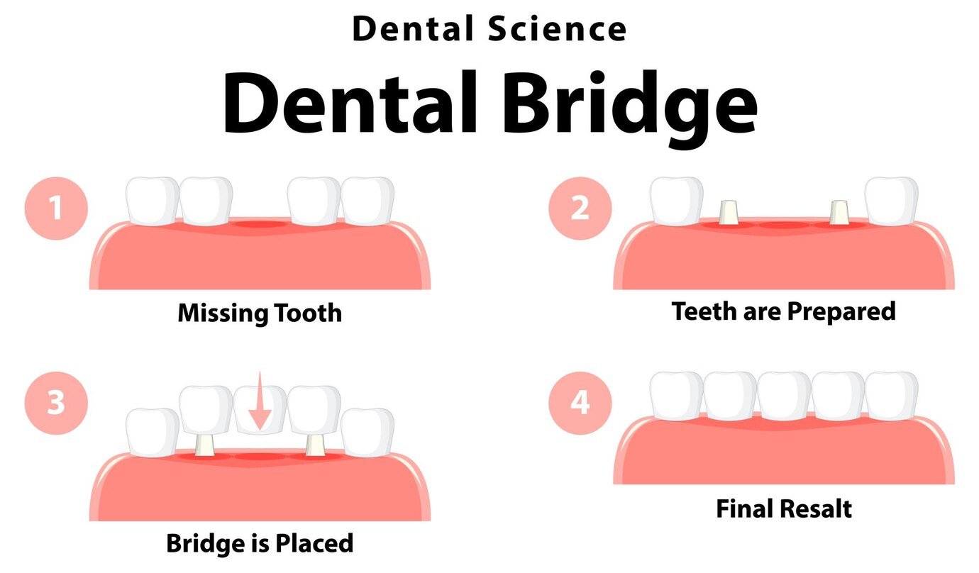 Porcelain Dental Bridge Options in Scarborough