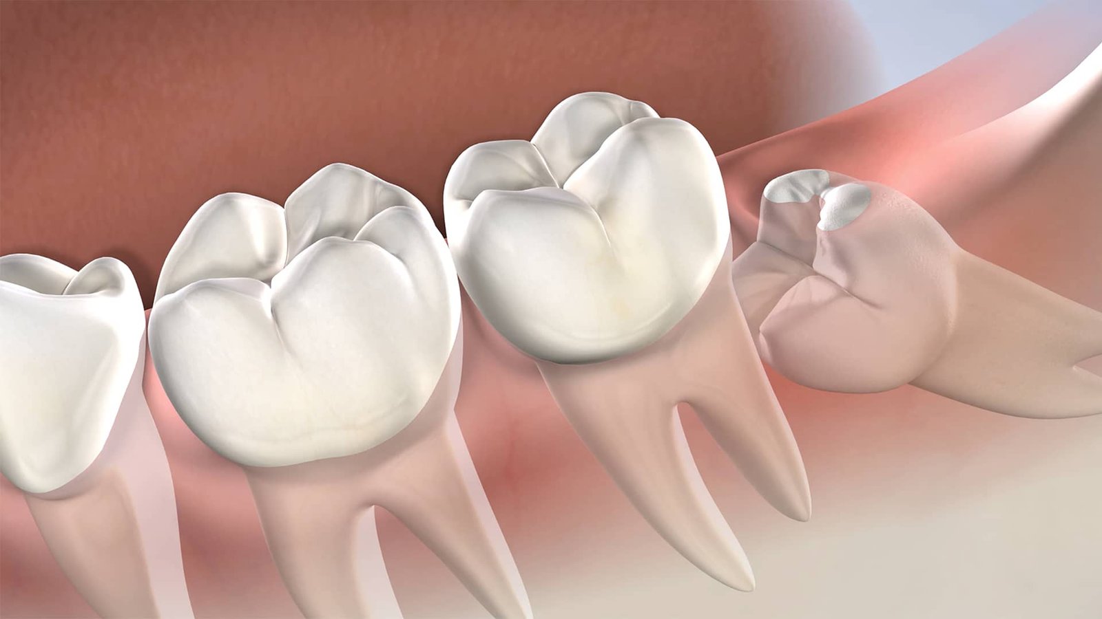 Recovery Tips After Wisdom Teeth Removal in Scarborough