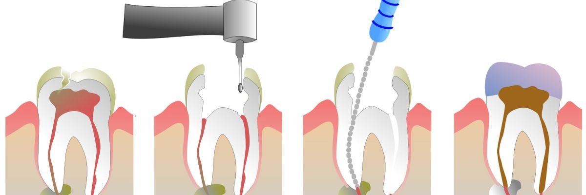 Root canal procedure steps in Scarborough