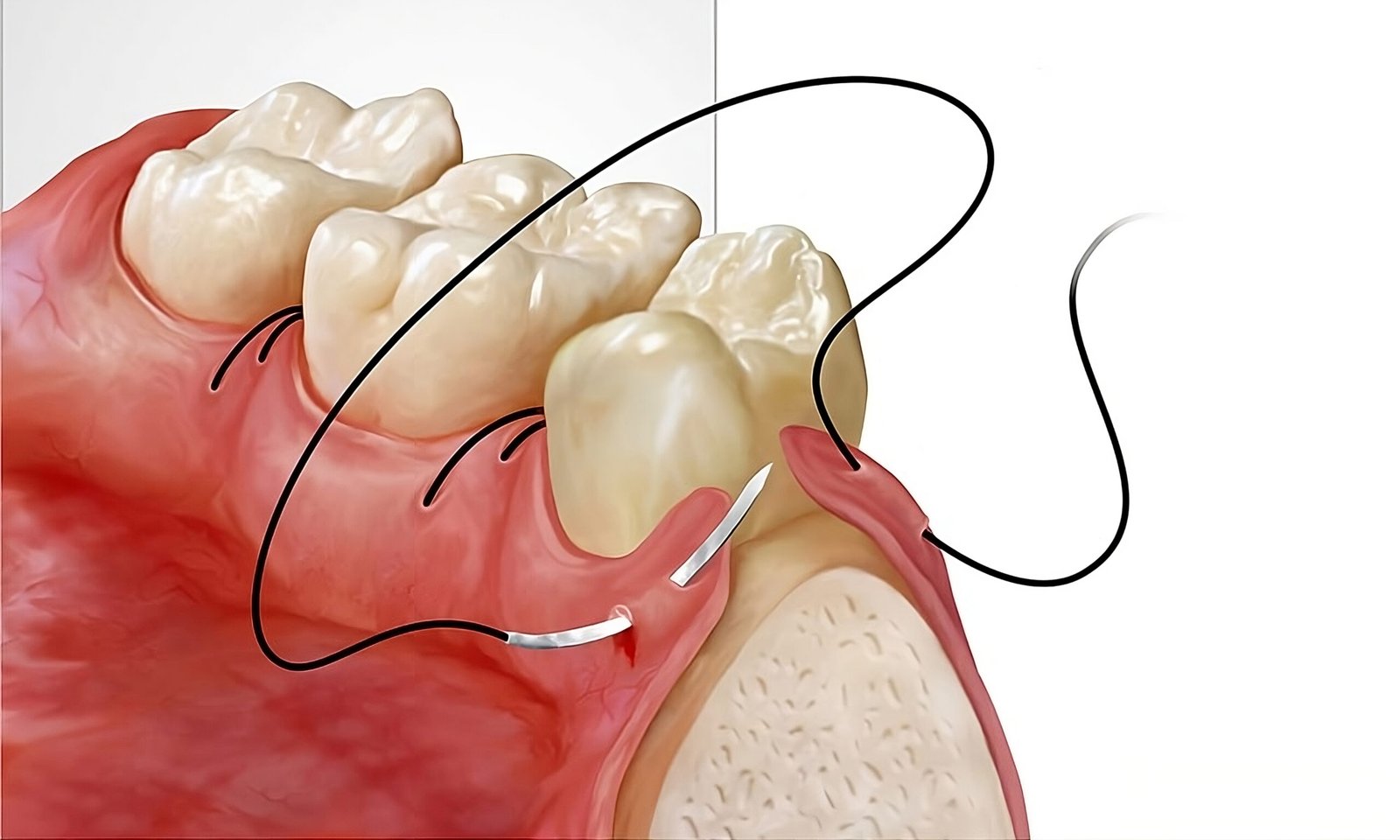Tooth removal dental surgery in Scarborough